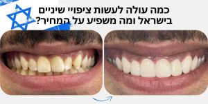 כמה עולה ציפוי שיניים